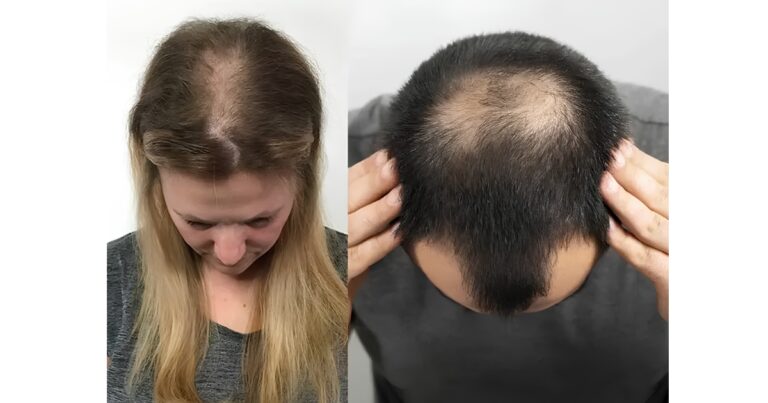 हेयर फॉल का पहला संकेत क्या है? बाल झड़ने से पहले दिखने लगते हैं ये लक्षण, समय रहते हो जाएं सतर्क